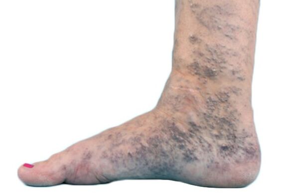 Vene varicose sulle gambe