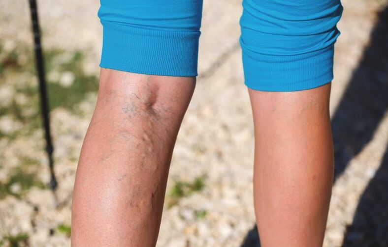 Danno alle estremità inferiori