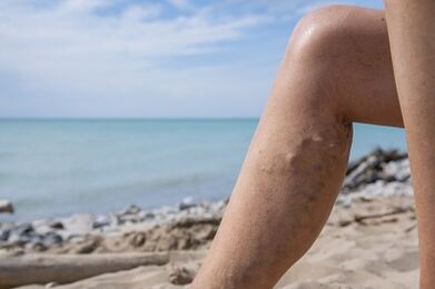Vene varicose sulle gambe