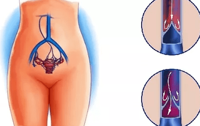 Le ragioni dello sviluppo delle vene varicose del bacino