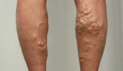 Sintomi di vene varicose