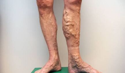 Vene varicose negli uomini