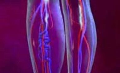 Cause e trattamento delle vene varicose