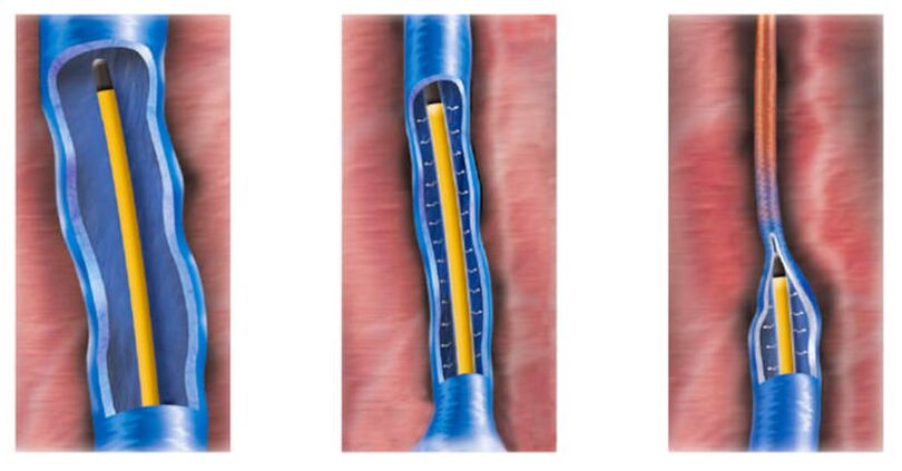 Ablazione con radiofrequenza come metodo per il trattamento delle vene varicose