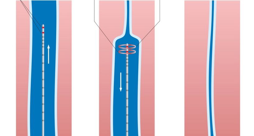 Trattamento laser delle vene varicose sulle gambe
